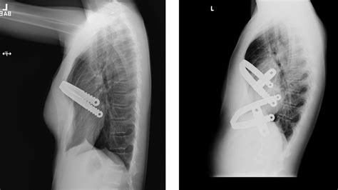 Securing a Nuss bar with a surgical zip tie - Mayo Clinic