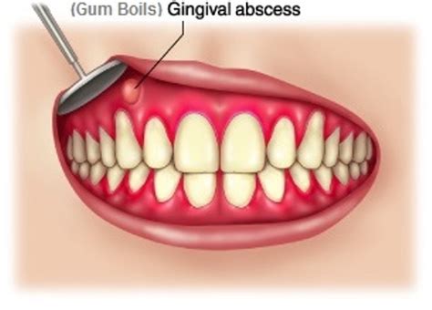 Gum Boils (Abscess) Lump, Blister, Pimple Pictures and Treatment