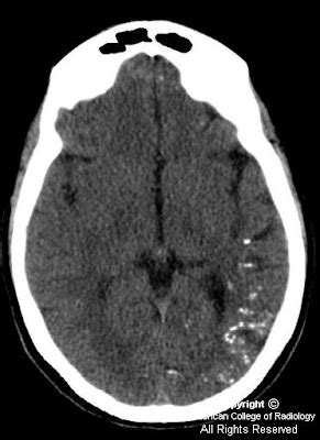 Neuroradiology On the Net: Rasmussen encephalitis