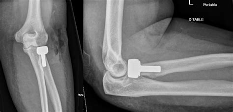 Radial Head Fracture | Orthopaedic Trauma Association (OTA)