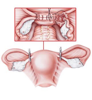 Hysterectomy - Danyel Berube