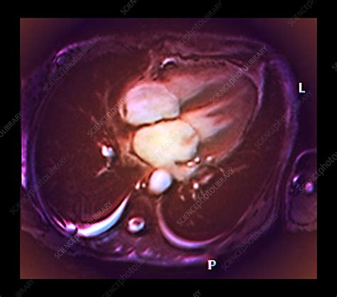 Cardiac mitral valve leak, MRI scan - Stock Image - C033/7383 - Science Photo Library