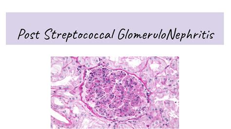 Post Streptococcal Glomerulonephritis( PSGN) - YouTube