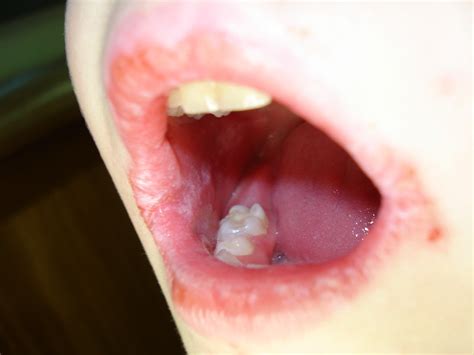 Dermatology For Dentists and Dental Students: Lips