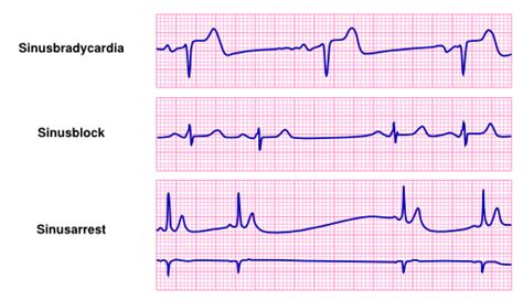 [最も欲しかった] sinus bradycardia with sinus arrhythmia 116016-Sinus bradycardia with sinus arrhythmia