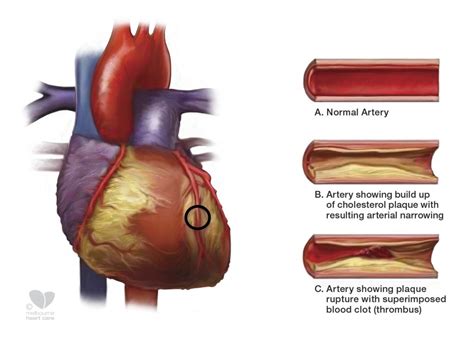 Atherosclerosis - Melbourne Heart Care