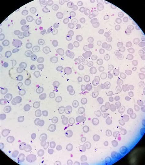 Peripheral blood smear of the second patient with severe anemia (Hb 1.8... | Download Scientific ...