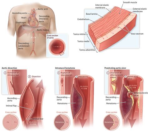 Aortic Dissection - Type A And B - Symptoms, Causes, Treatment