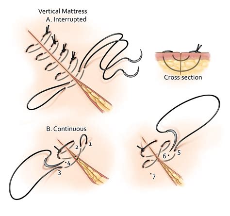 Suturing and Closure | The Neurosurgical Atlas, by Aaron Cohen-Gadol, M.D.