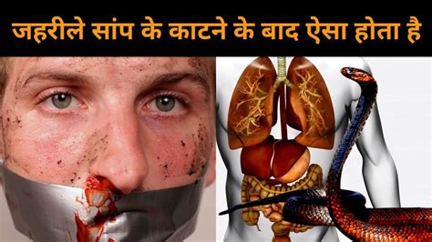 #snake_bite- Causes, Diagnosis, Symptoms.सांप काटे तो ऐसा लक्षण नजर आ सकता है - YouTube