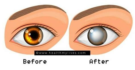 NIGHT BLINDNESS-CAUSES,SYMPTOMS,TREATMENT&PREVENTION