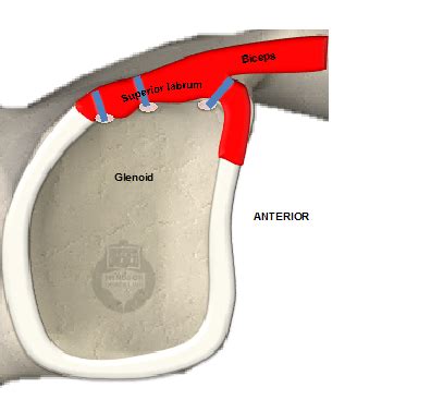 Arthroscopic SLAP repair (Superior Labral Repair)