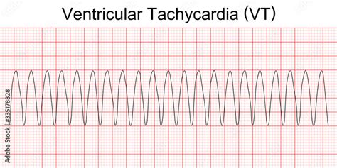 Electrocardiogram show monomorphic ventricular tachycardia (VT). Cardiac fibrillation. Heart ...