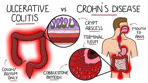 The Quickest Way to Test for Bowel Disease (Crohn's, IBD, UC or SIBO) : pandoratopのblog