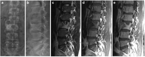 Imaging the Spine in Arthritis: a Pictorial Review | EP Wellness & Functional Medicine Clinic