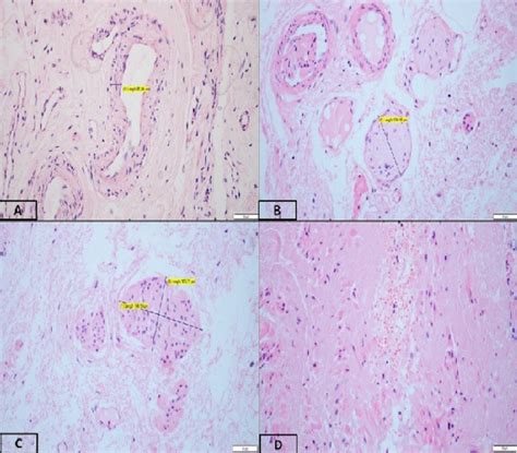 Figure 1 from Comparison of histomorphological findings of cardinal ...