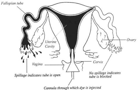 Infertility & HSGs | Carolina Conceptions