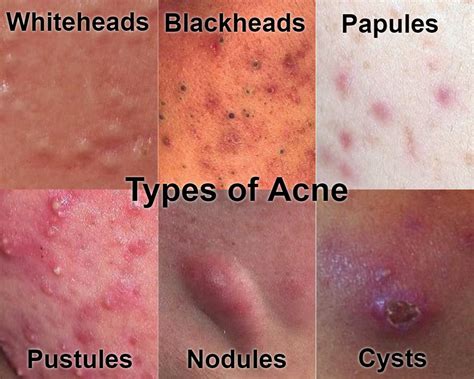 How Acne Forms, The Severe Pimples on Face and Other Part of Body - How Acne Forms