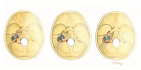 Temporal Bone Fractures, Encephaloceles, and Cerebrospinal Fluid Leaks – Oto Surgery Atlas