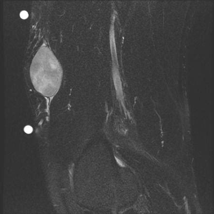 Myxofibrosarcoma | Image | Radiopaedia.org