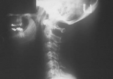 Cervical Sprain or Strain | Musculoskeletal Key