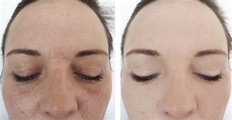 woman wrinkles face before and after procedures - Toronto Med Spa