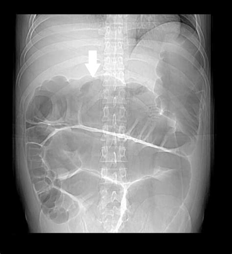 Cureus | Chronic Intestinal Pseudo-Obstruction in a Young Male With Alcohol Abuse Disorder