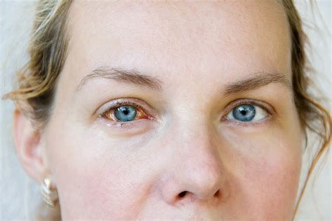 What is a Blocked Tear Duct? - Valley Eyecare