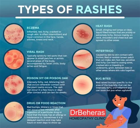 Rashes refer to inflamed,... - DrBeheras Homeopathy Clinic