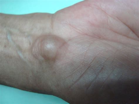 How I Treated a 66-year-old Female with Ganglion Cyst on the Wrist | ROJoson Medical Clinic