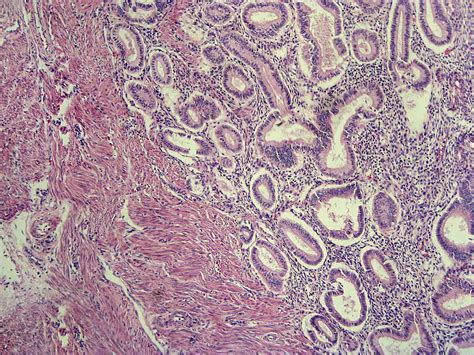 Endometrium: Anatomy, Function, and Related Conditions