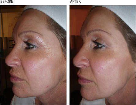 Retin-A (Tretinoin) is the ONLY thing that is PROVEN to reduce wrinkles ...