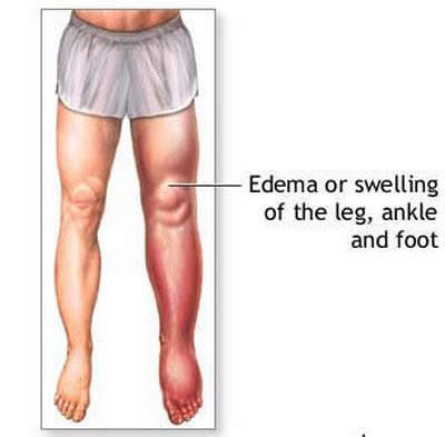 Uremia - Signs, Symptoms and Treatment