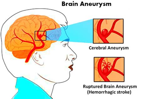 Symptoms of Brain Aneurysm: How to find Aneurysm in early days