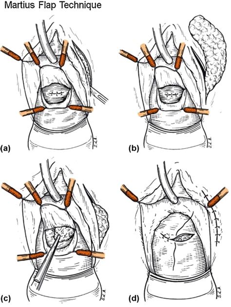 Surgical repair of rectovaginal fistulas in patients with Crohn's disease - European Journal of ...