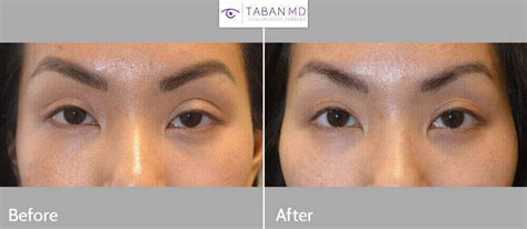 Revisional Eyelid Ptosis Surgery Before and After Gallery | Taban MD