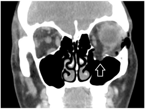 Ultimate Radiology Orbital Blow Out Fractures | My XXX Hot Girl