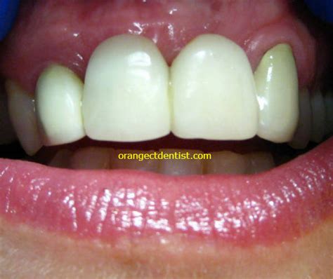 All Ceramic Crowns | Calcaterra Family Dentistry | Cosmetic Dentists