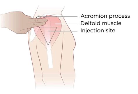 Intramuscular Injection: Definition and Patient Education