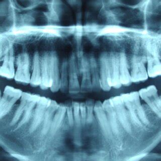 Panoramic radiograph (OPG) | Download Scientific Diagram