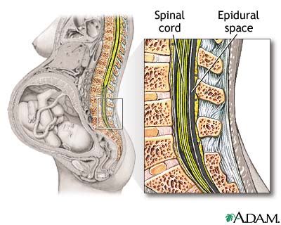 what is an epidural - prenatal vitamins