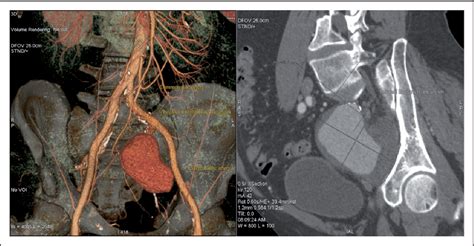 Figure 1 from A rare case of large isolated internal iliac artery ...