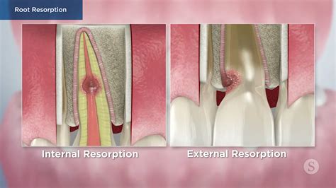 External Cervical Resorption—a Review Of Pathogenesis And, 50% OFF