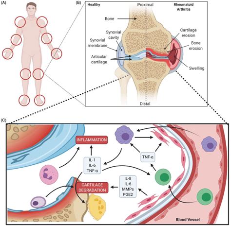 Pathophysiology Of Rheumatoid Arthritis Diagram