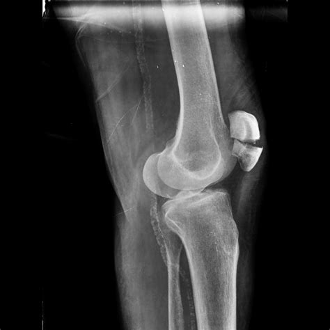 Patellar fracture | Image | Radiopaedia.org