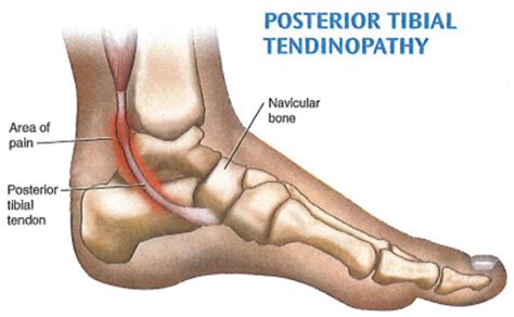 Posterior tibial tendonitis and tendinopathy: causes, symptoms ...