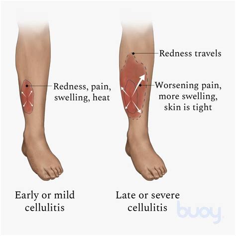 Cellulitis Knee