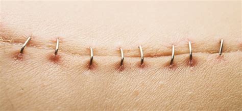 How Long Do Surgical Staples Stay In? | Livestrong.com