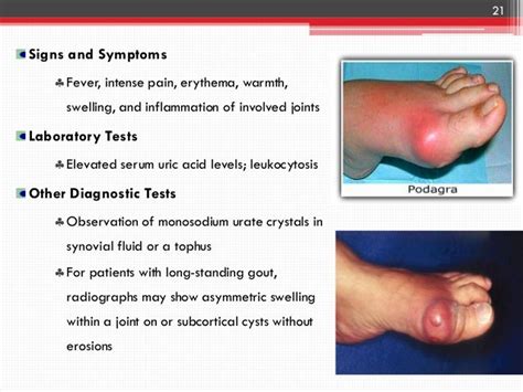 Gout & Hyperuricemia