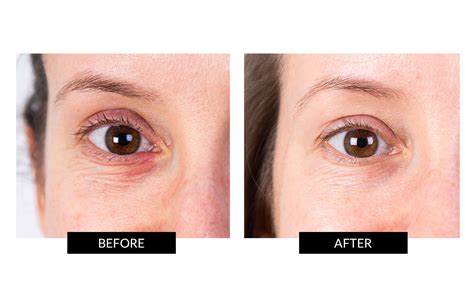 Everything You Need To Know About Brightening Your Undereyes | CurrentBody